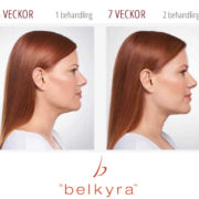 Belkyra på Karlstads Kirurgiska Laserklinik