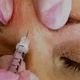 Botox tävling