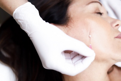 Trådlift behandling på Karlstads Kirurgiska Laserklinik