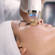 Microneedling-RF